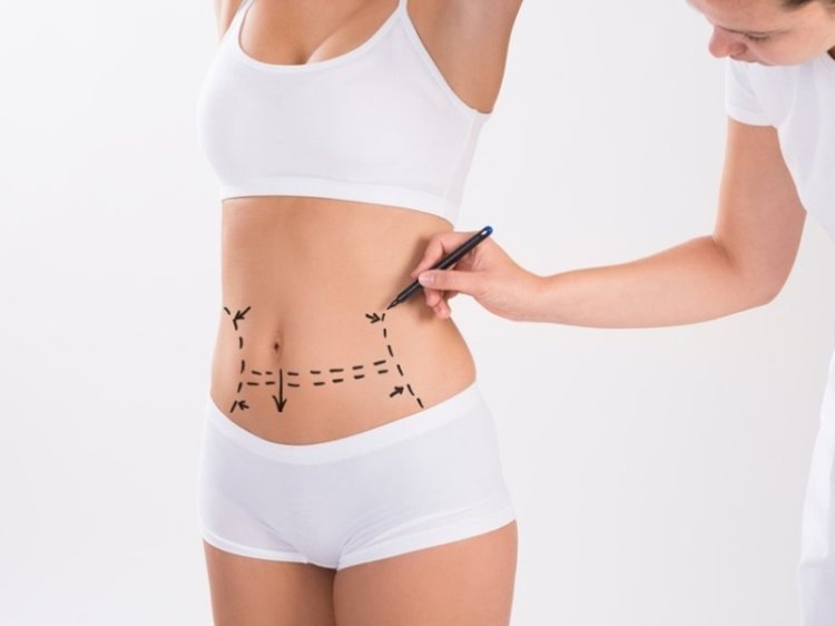 Skin Tightening and Tummy Tuck in Islamabad