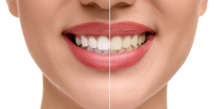 What Tiny Habits Drive Up Teeth Whitening Cost?
