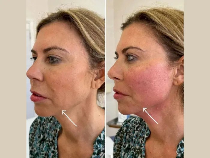 What to Expect During Your First Endolift in Dubai Treatment