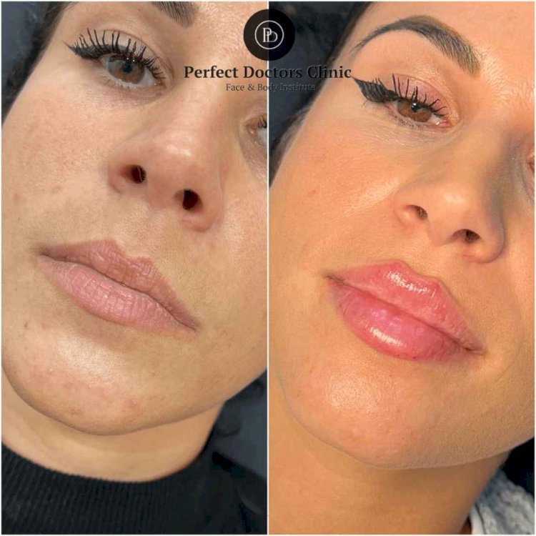 The Secret to Youthful Skin with Juvederm: A Step-by-Step Guide from the Best Plastic Surgeon in Dubai