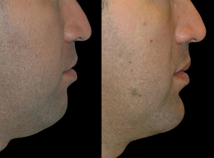 A Step-by-Step Guide to Chin Fillers with the Best Plastic Surgeon in Dubai