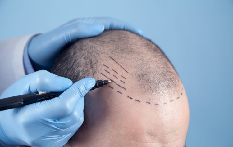 Can You Get a Crown Hair Transplant at Age 25?