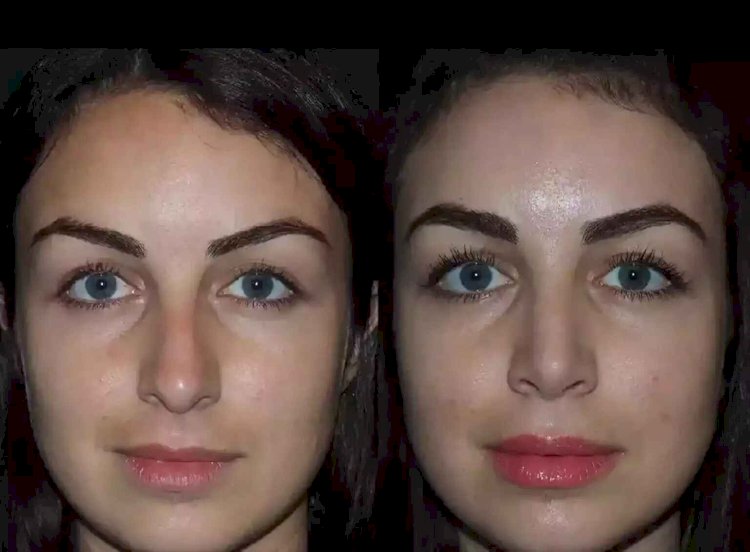 How Best Septoplasty Surgeons in Dubai Are Redefining Nasal Health
