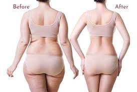 Sculpt Your Best You: Expert Body Contouring, Liposuction & 6-Pack Abs Surgery in Gurgaon