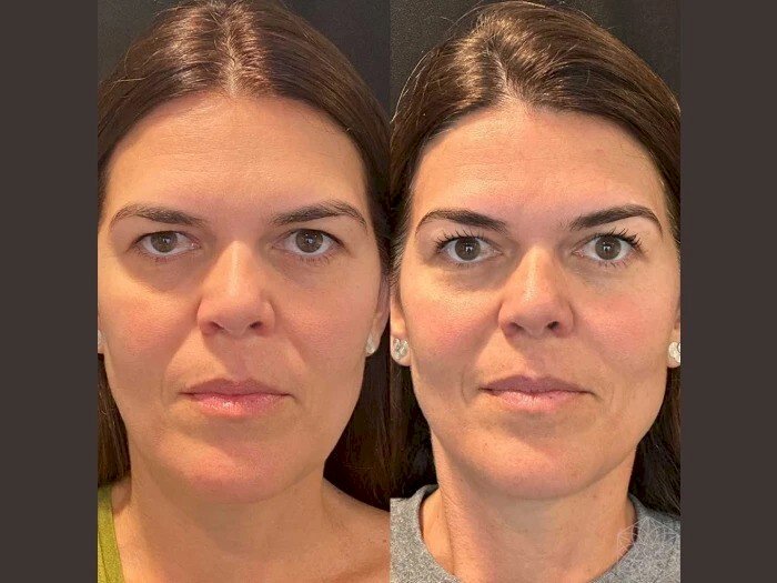 Rejuvenate Naturally with Thread Lift from the Best Doctors in Dubai