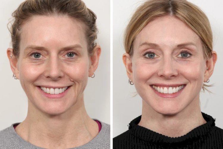 Thread Lift Treatments in Dubai for Mid-Face Lift