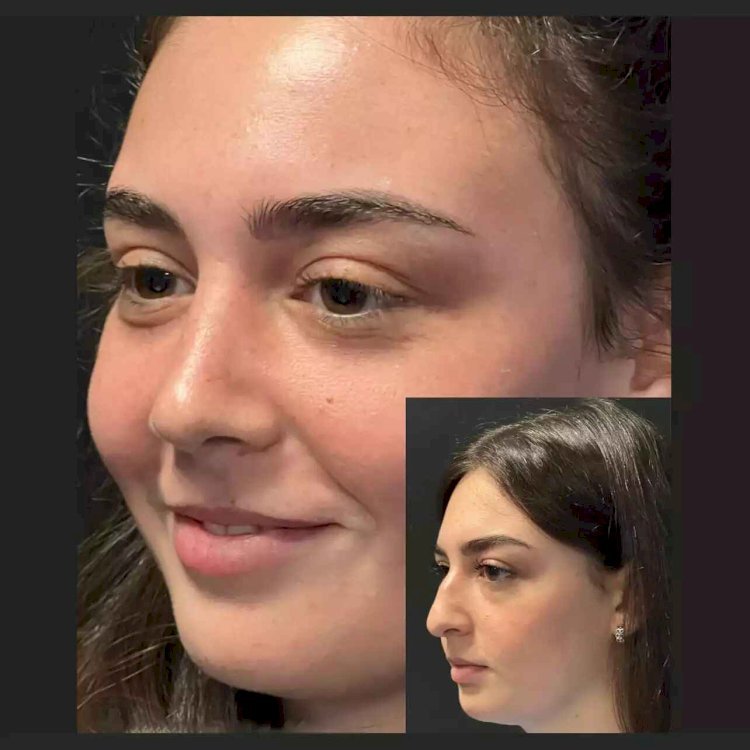 What Results Can the Best Septoplasty Surgeons in Dubai Deliver?