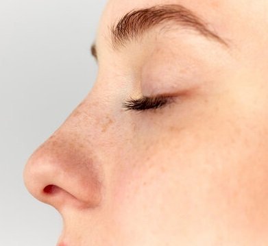What is Rhinoplasty in Islamabad? A Complete Beginner’s Guide