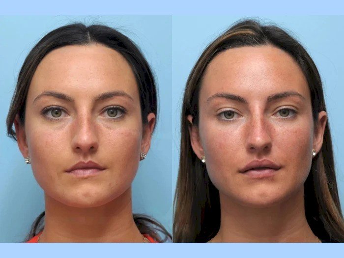 Achieve Flawless Contours Using Thread Lift Provided by the Best Doctors in Dubai