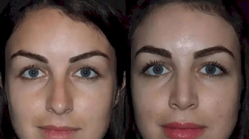 Rhinoplasty in Dubai: Enhancing Beauty and Breathing
