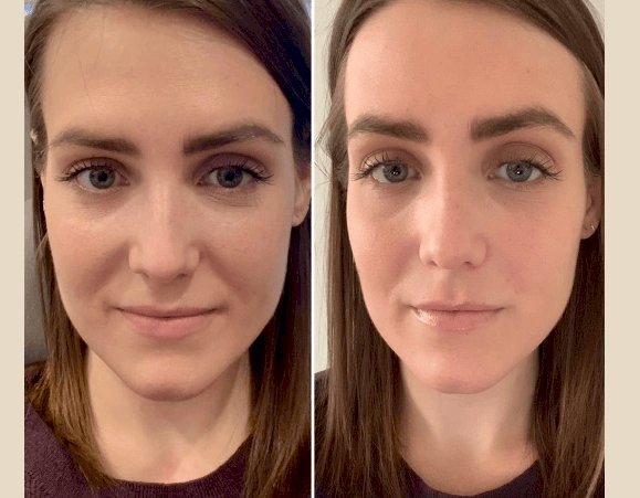 PRP Treatment in Dubai: What to Expect During Your First Session