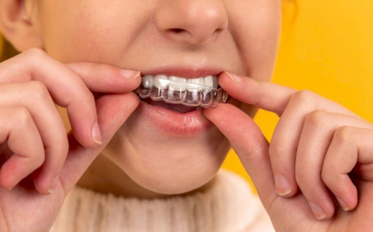 Do You Need Retainers After Invisalign Braces Treatment?