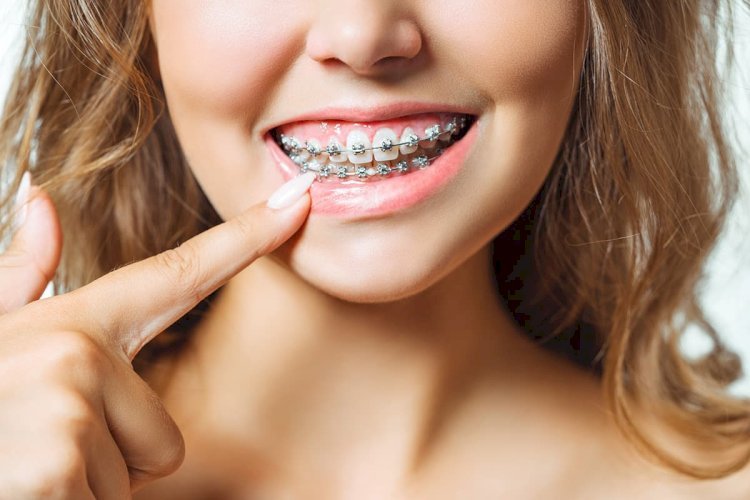 How Do Teeth Braces Costs in Dubai Impact Treatment Choice?