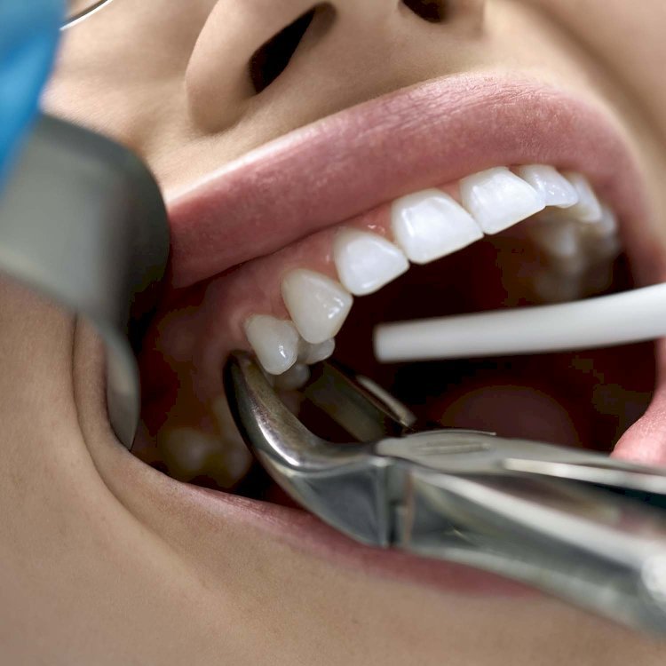 Are Tooth Extractions Cheaper Than Root Canals?