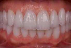 Does Full Mouth Rehabilitation Involve Orthodontics?
