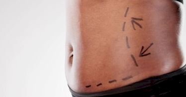 Liposuction Cost in Pakistan: Breaking Down Prices, Factors, and Real Patient Insights