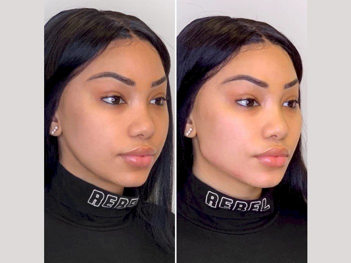 Enhance Confidence Through Affordable Thread Lift Treatments in Dubai Options