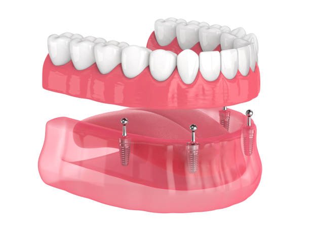 How to Choose the Right Dentures for Your Needs 