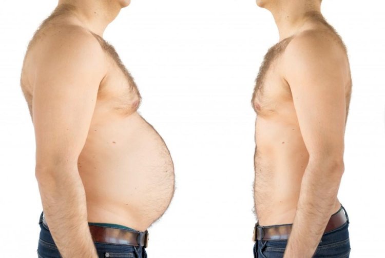 Bariatric Surgery Myths vs. Facts in Islamabad
