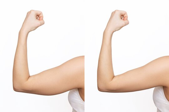Why "Ozempic Body" Patients are Flocking to Arm Lift Surgery in Riyadh