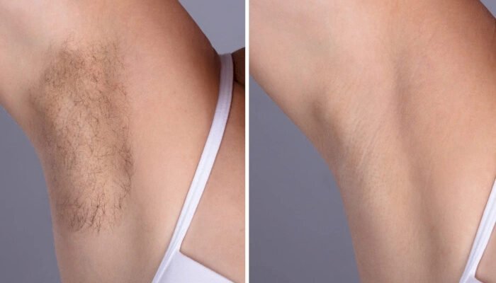 Laser hair removal in Dubai: Full Body Coverage