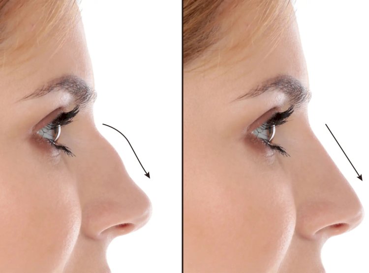 Best Septoplasty Surgeons in Dubai for Evidence-Based Correction