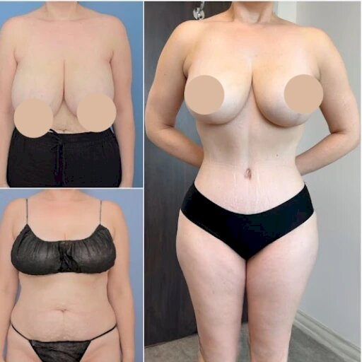 Best Doctors in Dubai for Tummy Tuck and Safe Fat Removal