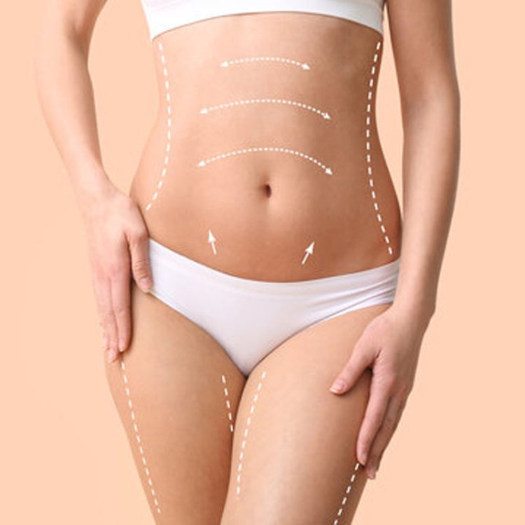 Liposuction for Different Body Types What Works Best?