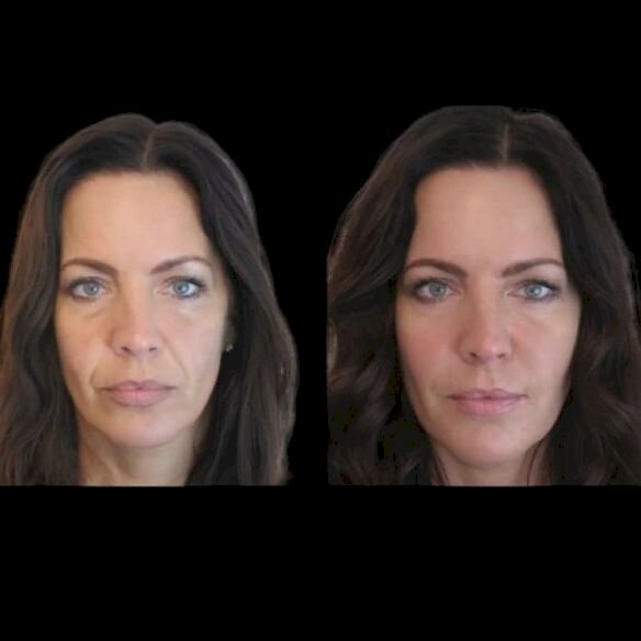 Best Plastic Surgeons in Dubai for Jawline Perfection with Jawline Fillers