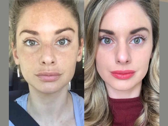 Non-Surgical Skin Lifting by the Best Plastic Surgeons in Dubai for Radiofrequency (RF) Microneedling