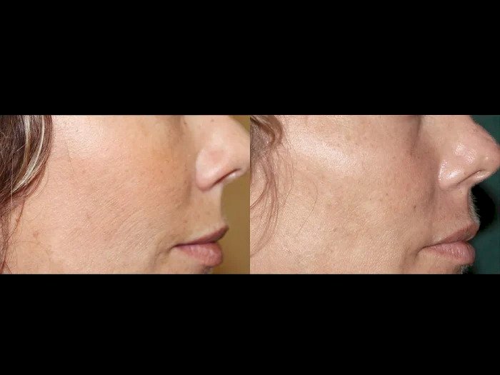 Collagen Renewal with Fractional RF Microneedling by the Best Plastic Surgeons in Dubai