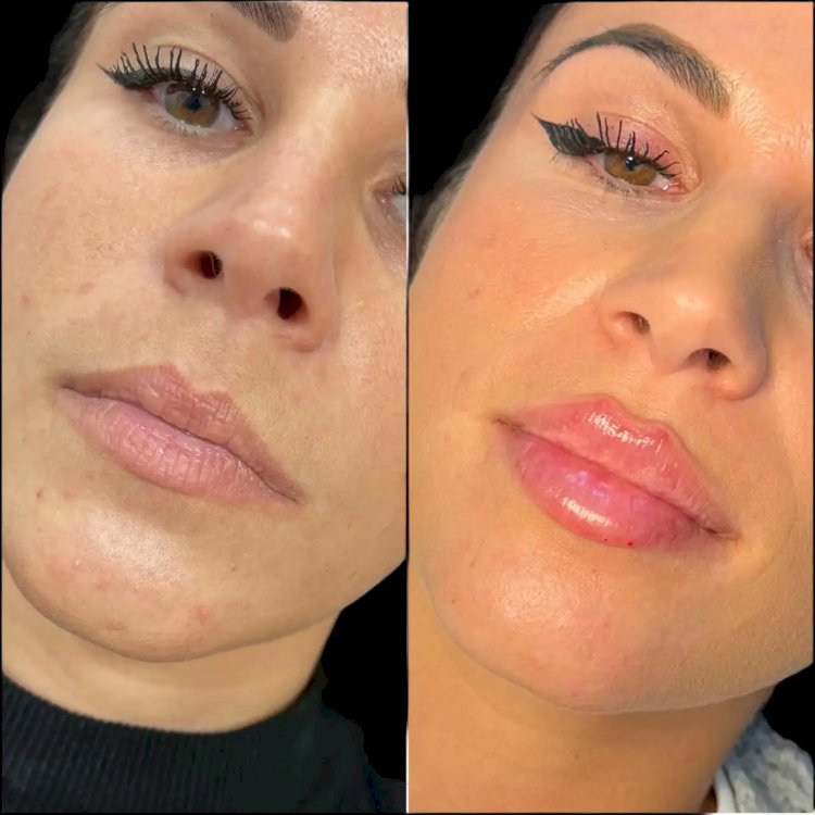 Dermal Fillers in Dubai for a Fresh and Radiant Look