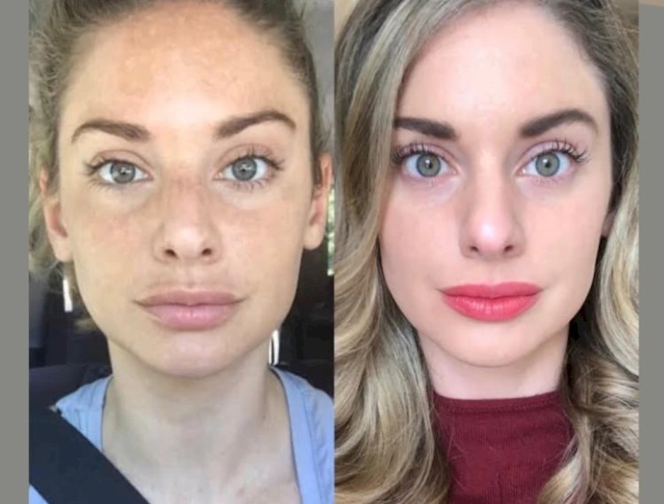 Premium RF Microneedling Treatment in Dubai for Anti-Aging