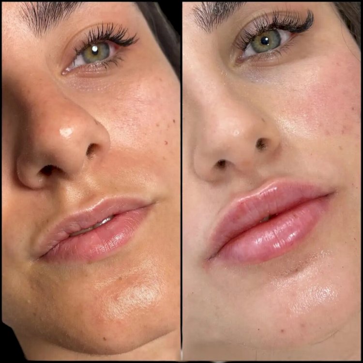 Best Doctors in Dubai for Fillers and Safe Aesthetic Procedures