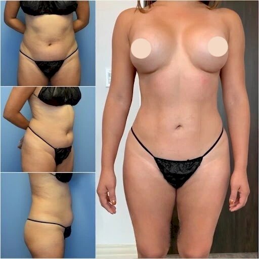 Best Doctors in Dubai for Tummy Tuck and Personalized Treatments