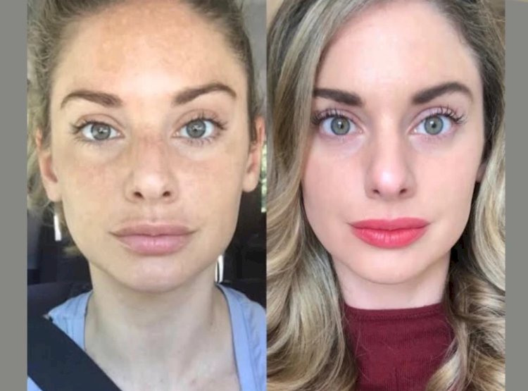 Why Radiofrequency (RF) Microneedling in Dubai Is Growing in Popularity