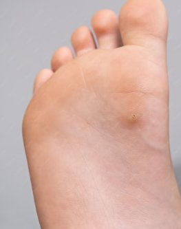 Wart vs Corn: Everything Athletes Need to Know
