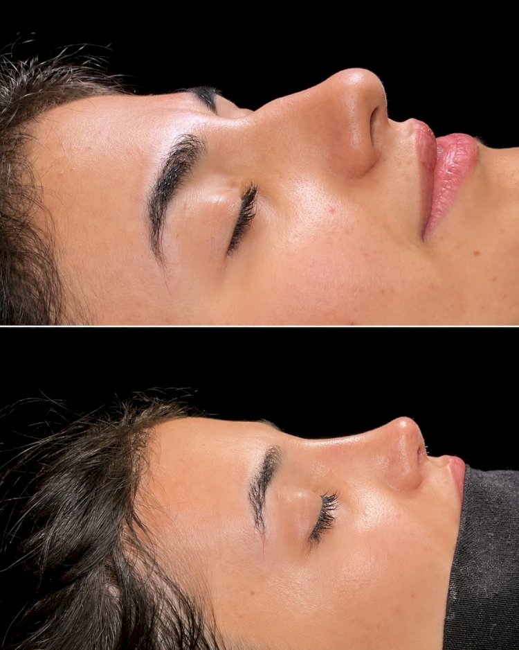 How Rhinoplasty in Islamabad Combines Medical Knowledge With Aesthetic Vision