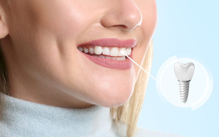 What Makes Someone a Good Candidate for Same-Day Dental Implants?