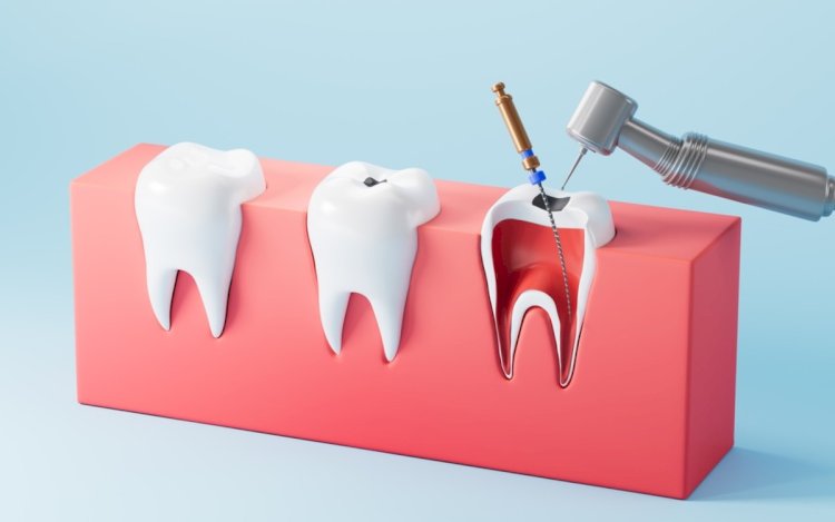 What Happens If You Delay Root Canal Treatment for an Infected Tooth?