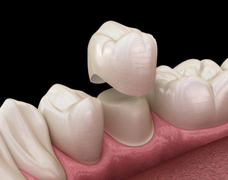 When Is a Cracked Tooth Better Treated With a Dental Crown?