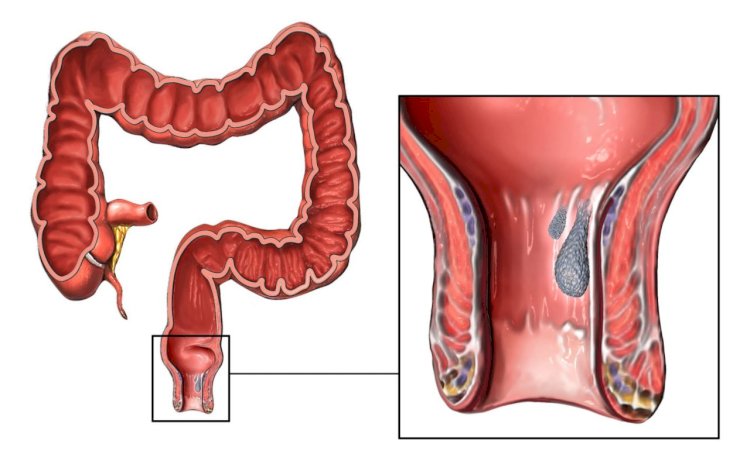 How to Identify the Initial Symptoms of Rectal Prolapse 