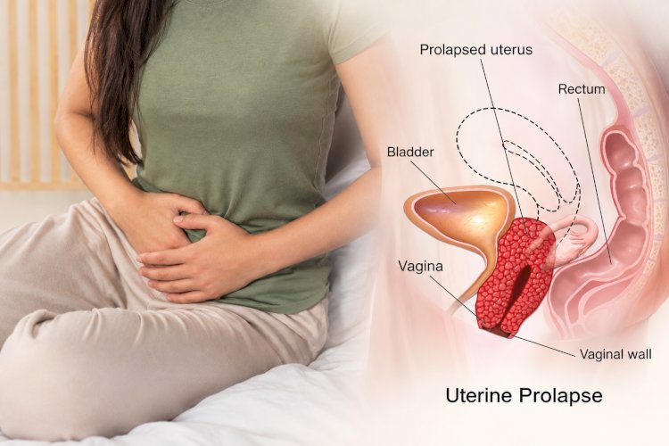 What You Should Avoid During Uterus Prolapse?